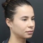 Aesthetic Facial Balancing Before & After Patient #1123