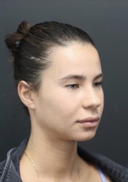 Aesthetic Facial Balancing Before & After Patient #1123