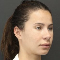 Aesthetic Facial Balancing Before & After Patient #1123
