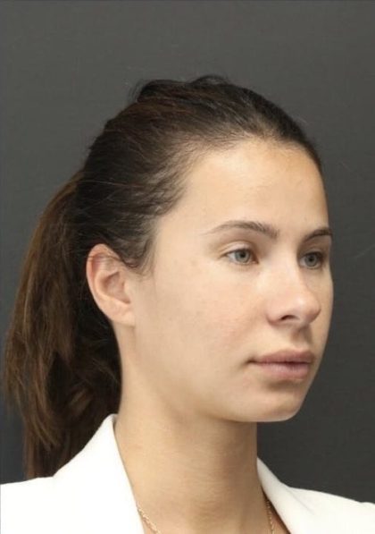 Aesthetic Facial Balancing Before & After Patient #1123