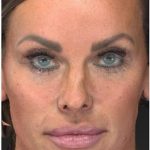 Aesthetic Facial Balancing Before & After Patient #1122