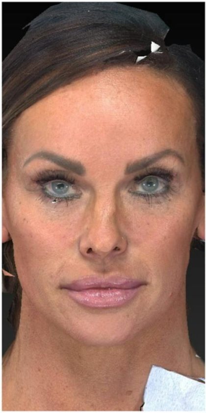 Aesthetic Facial Balancing Before & After Patient #1122