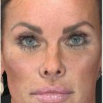Aesthetic Facial Balancing Before & After Patient #1122