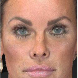 Aesthetic Facial Balancing Before & After Patient #1122