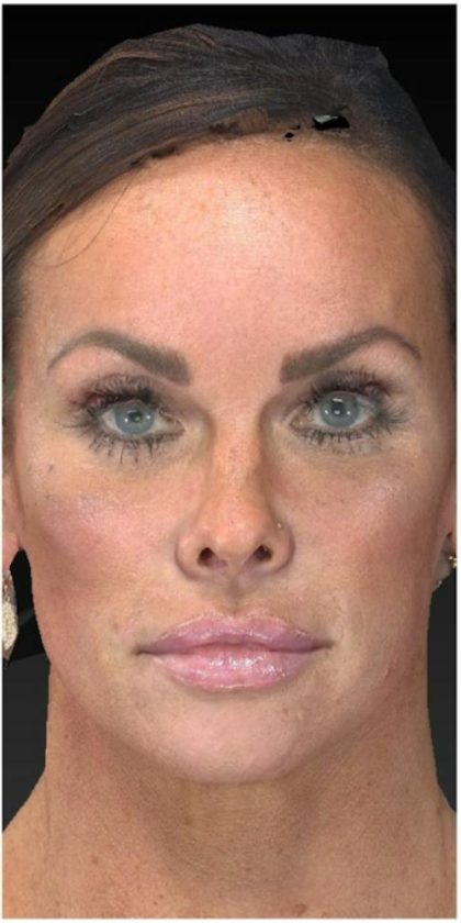 Aesthetic Facial Balancing Before & After Patient #1122
