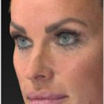 Aesthetic Facial Balancing Before & After Patient #1122
