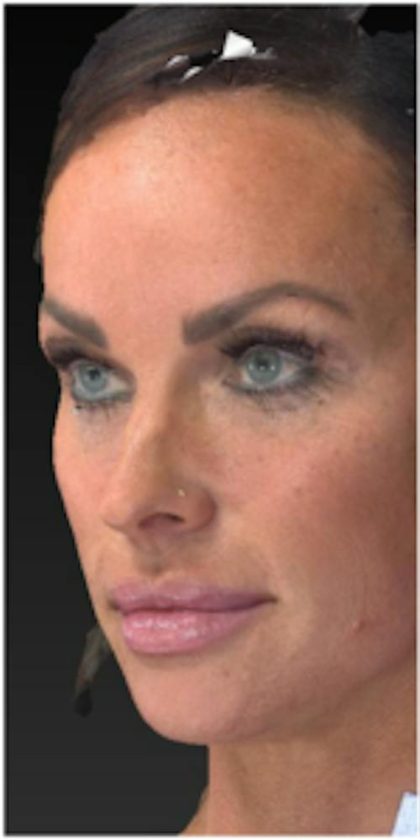 Aesthetic Facial Balancing Before & After Patient #1122