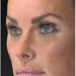 Aesthetic Facial Balancing Before & After Patient #1122