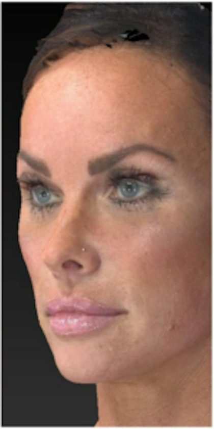 Aesthetic Facial Balancing Before & After Patient #1122