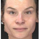 Aesthetic Facial Balancing Before & After Patient #1121
