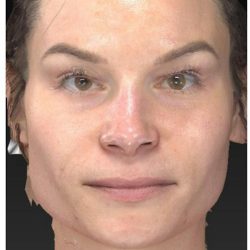 Aesthetic Facial Balancing Before & After Patient #1121