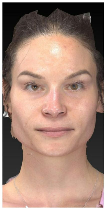 Aesthetic Facial Balancing Before & After Patient #1121