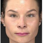 Aesthetic Facial Balancing Before & After Patient #1121