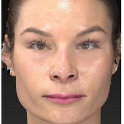 Aesthetic Facial Balancing Before & After Patient #1121