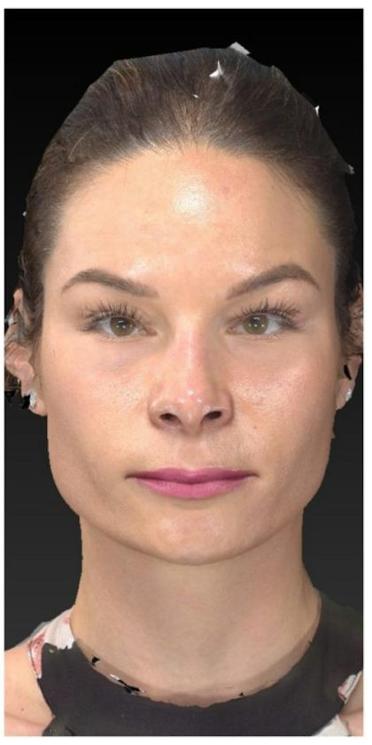 Aesthetic Facial Balancing Before & After Patient #1121