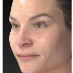 Aesthetic Facial Balancing Before & After Patient #1121