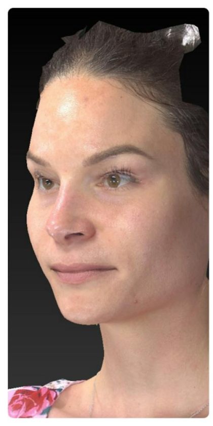 Aesthetic Facial Balancing Before & After Patient #1121