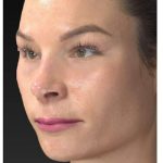 Aesthetic Facial Balancing Before & After Patient #1121