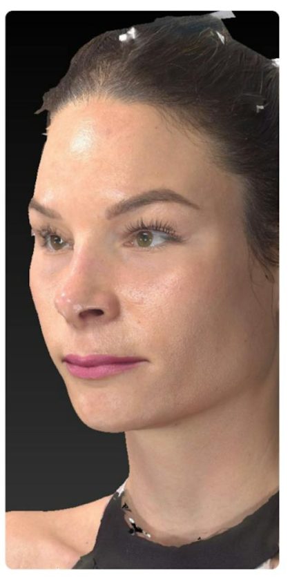 Aesthetic Facial Balancing Before & After Patient #1121