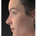 Aesthetic Facial Balancing Before & After Patient #1121