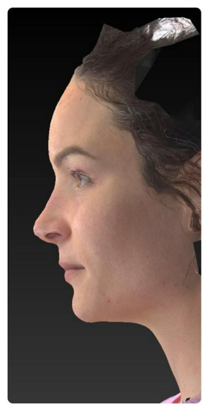 Aesthetic Facial Balancing Before & After Patient #1121