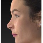 Aesthetic Facial Balancing Before & After Patient #1121