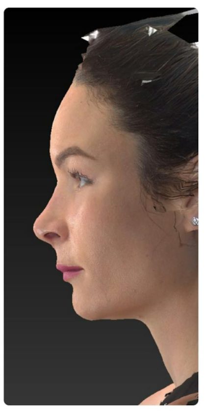Aesthetic Facial Balancing Before & After Patient #1121
