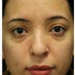 Aesthetic Facial Balancing Before & After Patient #1120