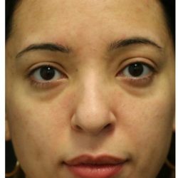 Aesthetic Facial Balancing Before & After Patient #1120