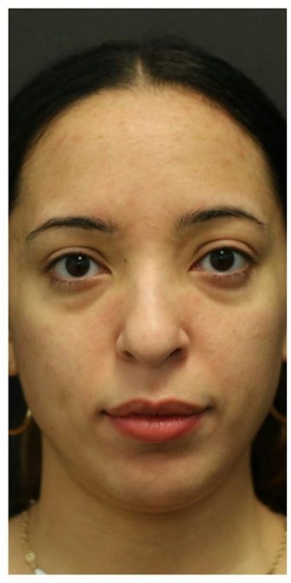 Aesthetic Facial Balancing Before & After Patient #1120