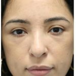 Aesthetic Facial Balancing Before & After Patient #1120
