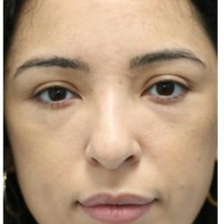 Aesthetic Facial Balancing Before & After Patient #1120
