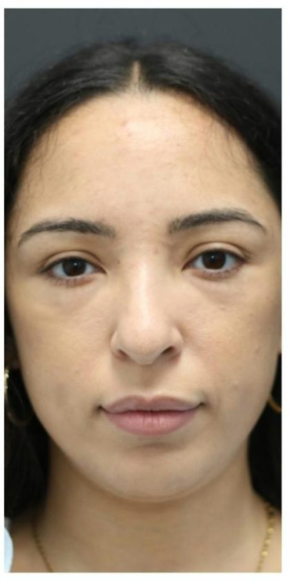 Aesthetic Facial Balancing Before & After Patient #1120