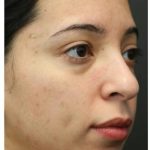 Aesthetic Facial Balancing Before & After Patient #1120