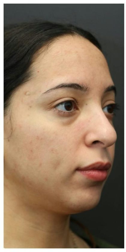 Aesthetic Facial Balancing Before & After Patient #1120