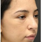 Aesthetic Facial Balancing Before & After Patient #1120