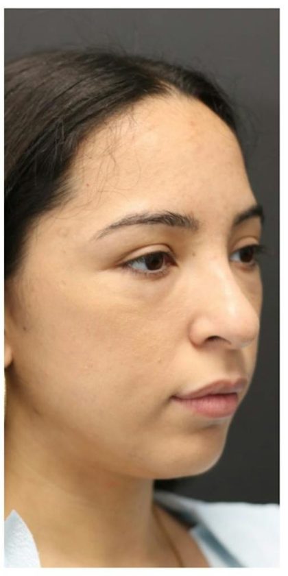 Aesthetic Facial Balancing Before & After Patient #1120