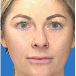 Aesthetic Facial Balancing Before & After Patient #1119