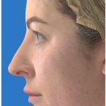 Aesthetic Facial Balancing Before & After Patient #1119