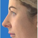 Aesthetic Facial Balancing Before & After Patient #1119