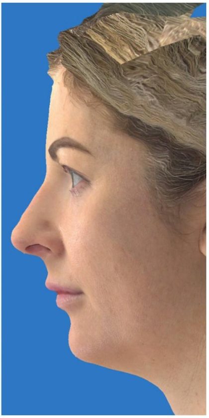 Aesthetic Facial Balancing Before & After Patient #1119
