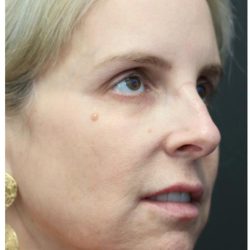 Aesthetic Facial Balancing Before & After Patient #1118