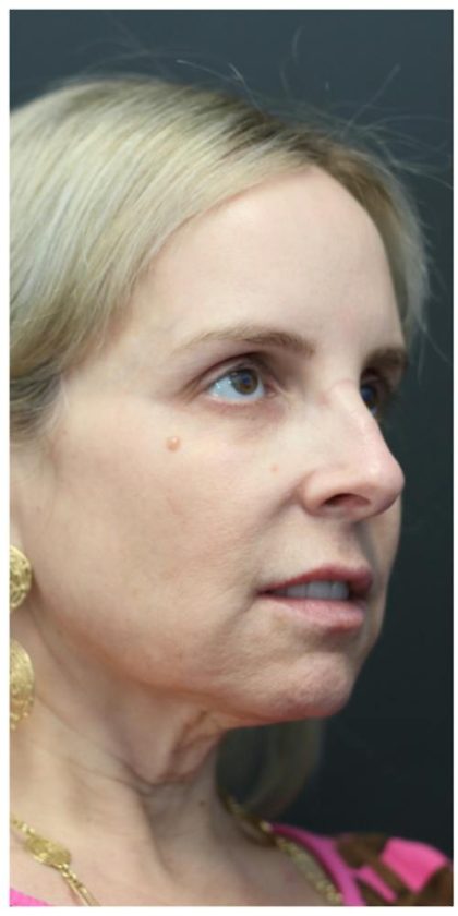 Aesthetic Facial Balancing Before & After Patient #1118