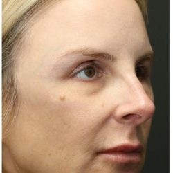 Aesthetic Facial Balancing Before & After Patient #1118