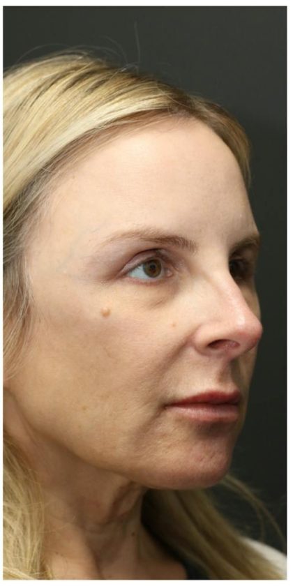 Aesthetic Facial Balancing Before & After Patient #1118