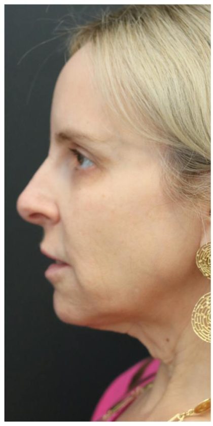 Aesthetic Facial Balancing Before & After Patient #1118