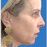 Aesthetic Facial Balancing Before & After Patient #1118