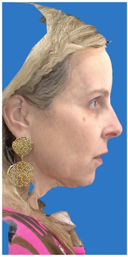 Aesthetic Facial Balancing Before & After Patient #1118