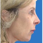 Aesthetic Facial Balancing Before & After Patient #1118