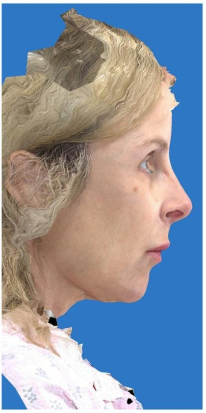 Aesthetic Facial Balancing Before & After Patient #1118